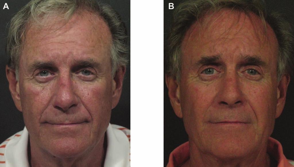 Fitzgerald et al 23S Figure 17. (A) This 60-year-old man presented for treatment of general facial aging.