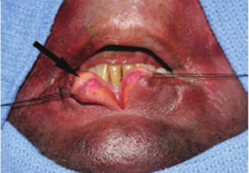 Vertical sectioning of the lower lip shows deep submuscular fat.