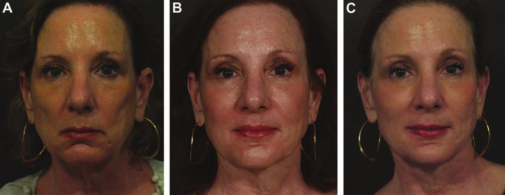 Fitzgerald et al 19S Figure 11. A, This 58-year-old woman presented for treatment of nasolabial folds. B, Midtreatment. C, Four months after the final treatment.
