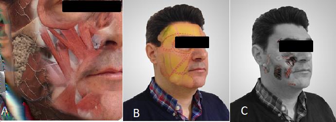 Citation: Page 2 of 5 Figure 2: Musculoskeletal structure of the face (A: Muscle structure; B: Fat areas of the face; C: Ligaments of the face).