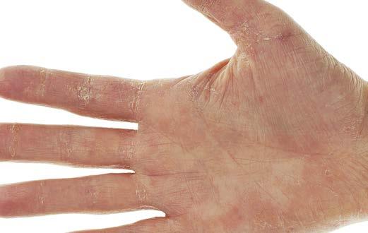 Dermatitis Is The Most Common Occupational Health Risk By far, skin diseases are the most common health hazard at the workplace.