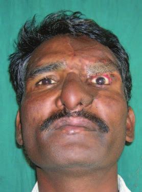 118 Nasal and periorbital reconstruction Reconstructive challenges: Eyelid reconstruction, eyebrow reconstruction, nose