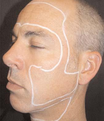 (Continued from page 24) FACIAL SKIN LAXITY Use lower fluences over bony areas such as the forehead.