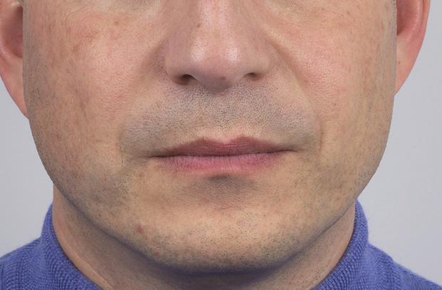other dermal fillers containing the same 50 H monophasic gel (H 24mg/ml + lidocaine 0,3%) H biphasic gel