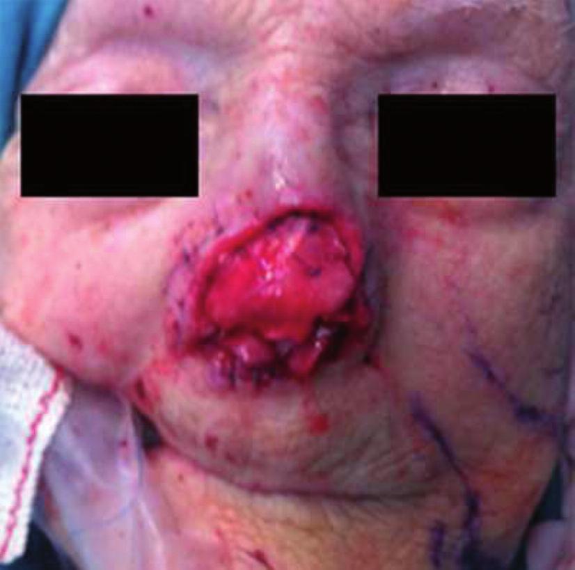 covered with an extended nasolabial flap.