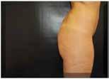 (Pic 3-4-5) In case of liposculpture of abdomen or lower limbs,