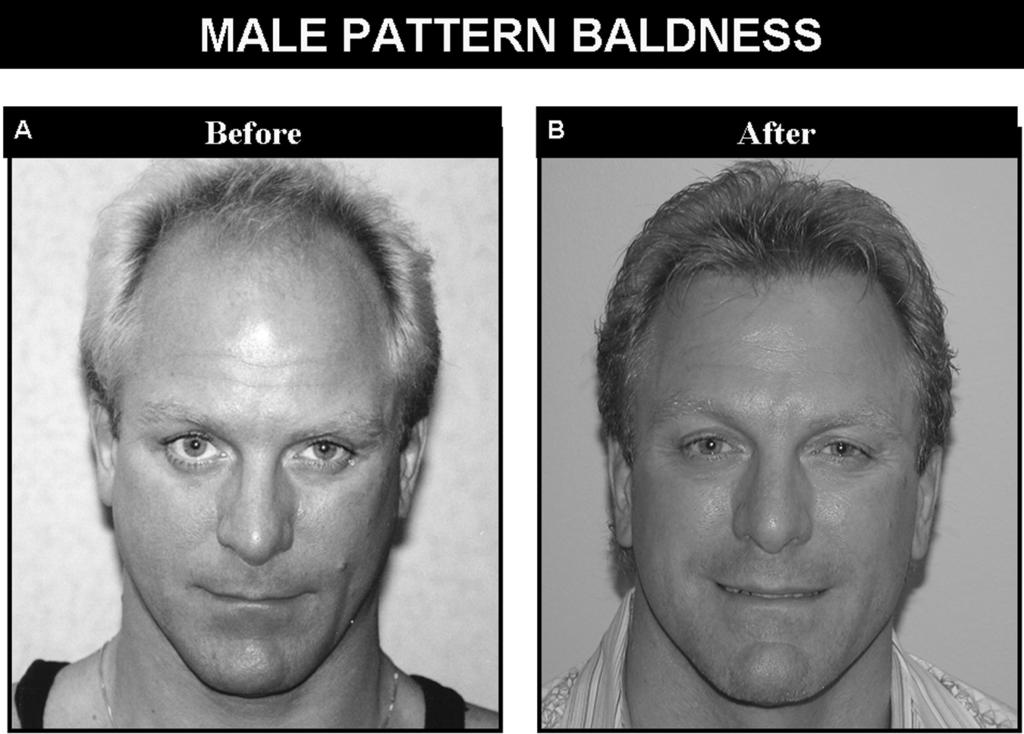 184 Shapiro et al. PRACTICAL APPLICATIONS OF HAIR TRANSPLANTATION Male-pattern baldness is the most common indication for hair transplantation.