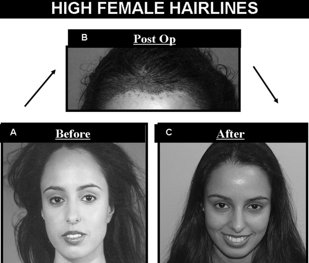 Hair Transplantation 187 FIGURE 7 Lowering a high female hairline. Many women wish to lower an abnormally high hairline. This can be done with transplants or hairline advancement surgery.