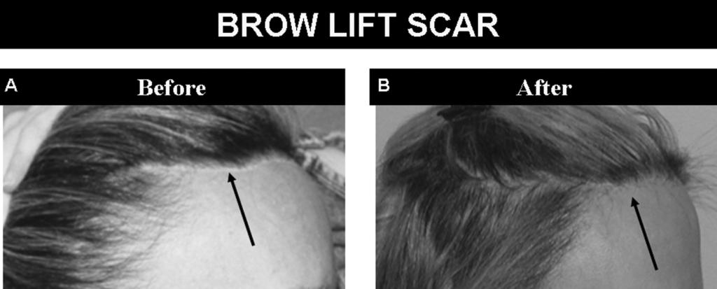 190 Shapiro et al. FIGURE 11 Brow-lift scar. Many patient use transplants to cover scars caused by facial plastic surgery such as brow lifts or face lifts. (A) Before (B) After.