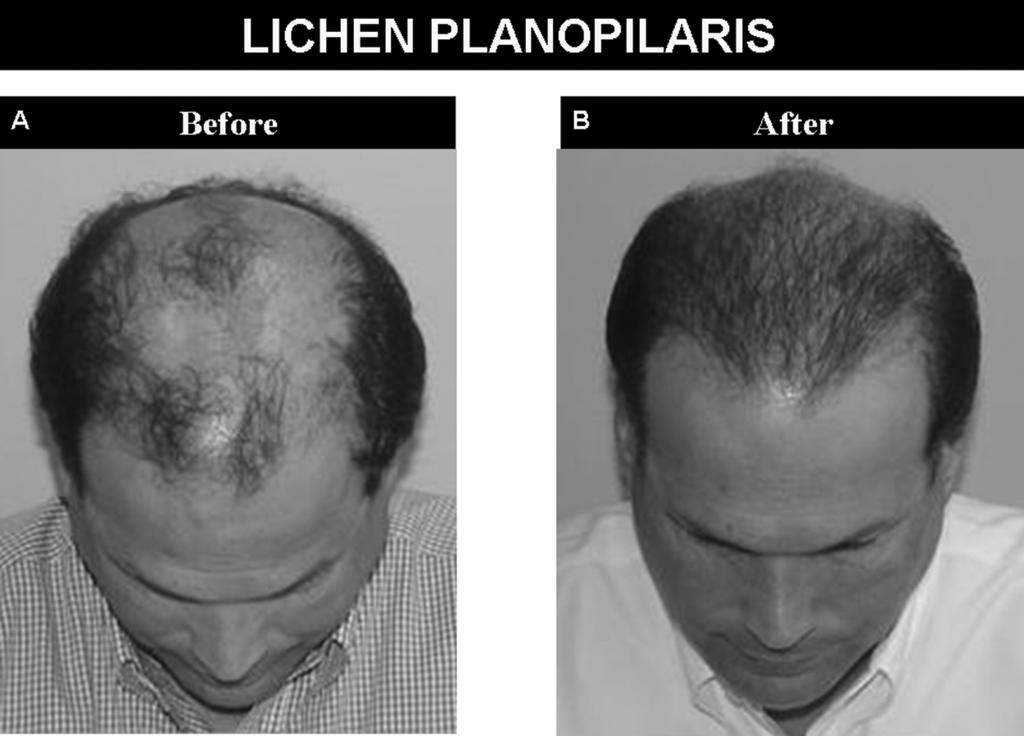 192 Shapiro et al. FIGURE 14 Lichen planopilaris. Though controversial, hair transplantation is being used to treat areas of alopecia in burned-out cicatricial alopecia.