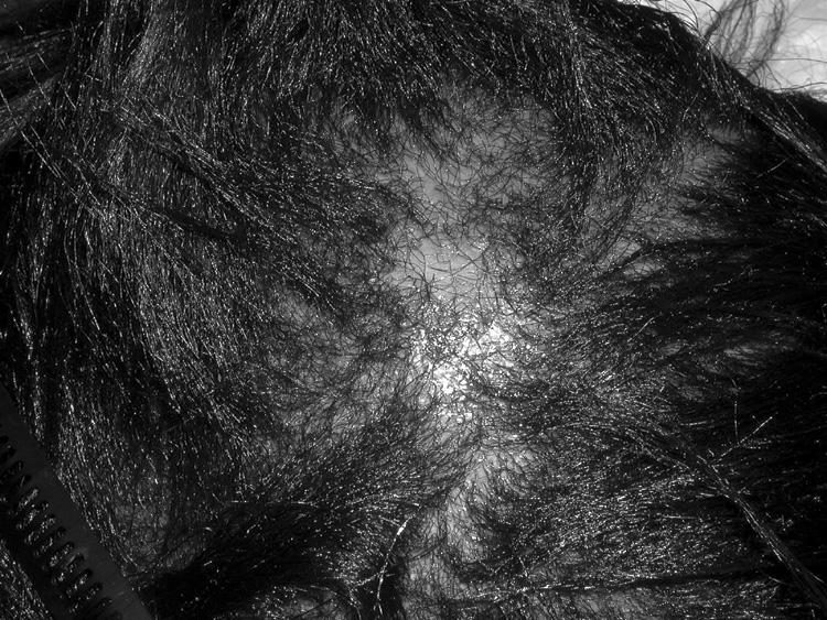 Hair Transplantation 193 (A) (B) (C) FIGURE 15 Central centrifugal cicatricial alopecia (CCCA).