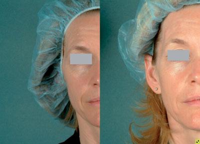 SKIN TIGHTENING: RF VS. LASER 173 Fig. 6. Tissue tightening by radiofrequency treatment of the right side of the face.