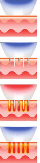 How it works Secret RF microneedles gently penetrate the skin, causing minimal damage to the skin.