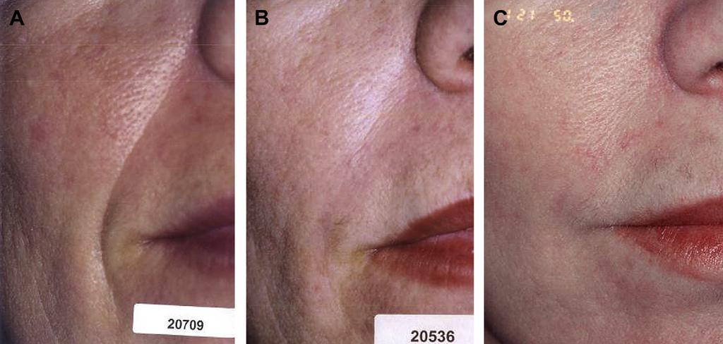 442 Jones Fig. 8. Results of ArteFill for the treatment of nasolabial folds at pretreatment, 1 year posttreatment, and beyond 1 year posttreatment. (A) Pretreatment. (B) 1 year posttreatment.
