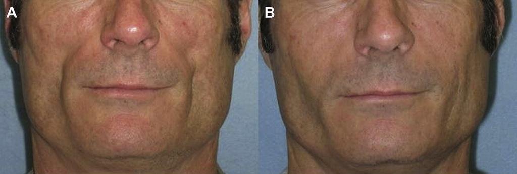 Semipermanent and Permanent Injectable Fillers 435 Fig. 3. (A, B) Pretreatment and posttreatment photographs of injection with Radiesse for HIV-associated facial lipoatrophy. (Courtesy of D.