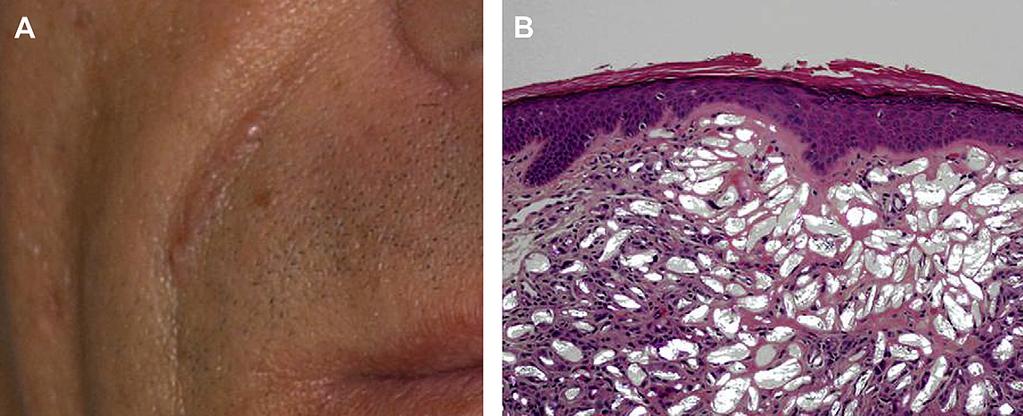 438 Jones contraindicated in the lips, in individuals with known hypersensitivity to any of its components, or in patients with known history of or susceptibility to keloid formation or hypertrophic