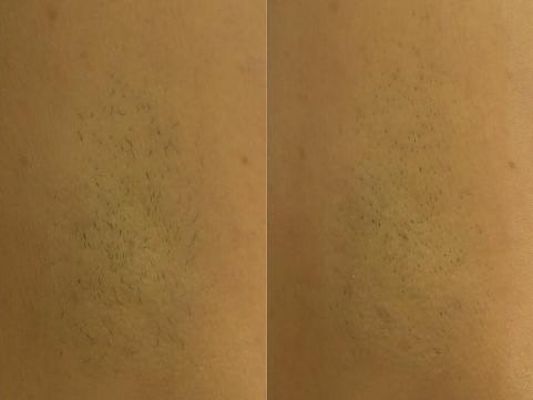 Figure 1. Two-week treatment interval photographs.