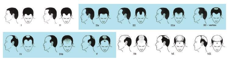 Doctors use a system known as the Norwood Hamilton Classification (men) and the Ludwig-Savin Classification (women) to describe the degree of hair loss.