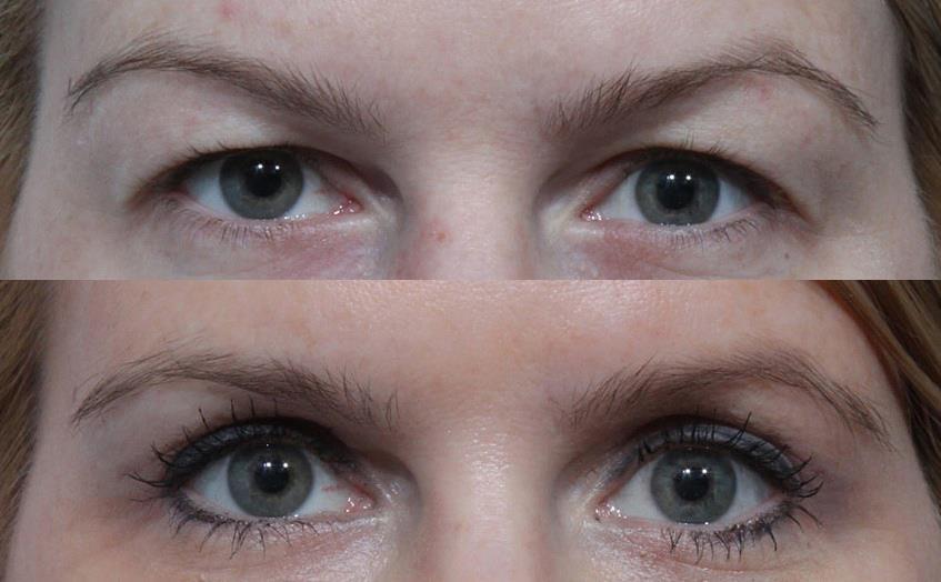 UPPER EYELID SURGERY BEFORE AND AFTER * Disclaimer Practiced at the level of the upper eyelids, a discreet incision hidden in the palpebral fold removes excess skin and the hernia that often exists