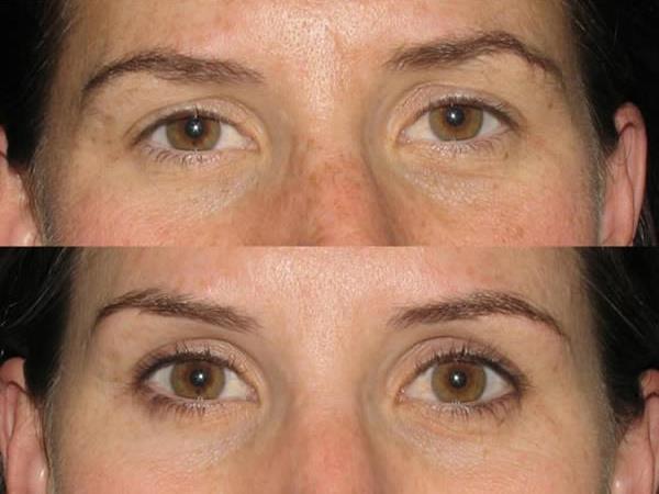 BOTOX BROW LIFT BEFORE AND AFTER * Disclaimer Is an Eyelid Lift Possible Without Surgery Using Botox Brow Lift?