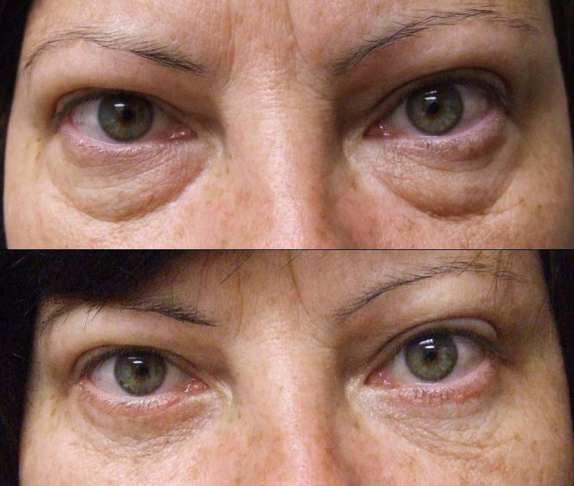 LOWER EYELID SURGERY When it comes to removing excess fat deposits from under the patient s eye, surgeons often recommend lower eyelid surgery.