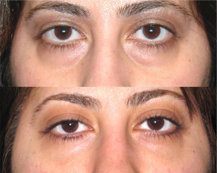 Lower Eyelid Surgery Aftercare After an eyelid operation, the recovery period begins.