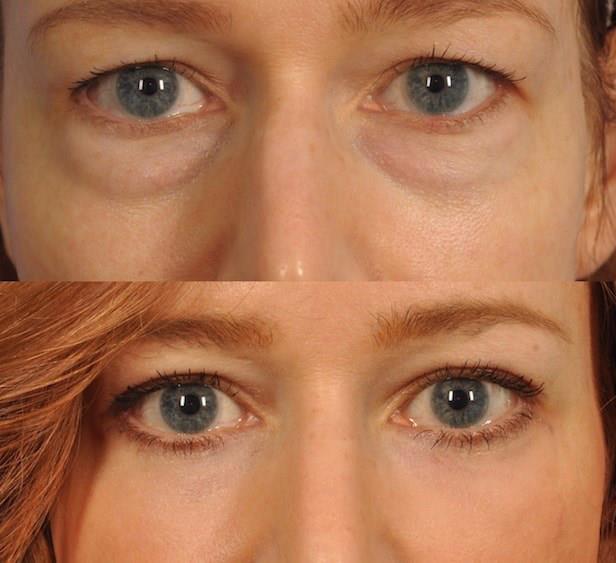 What is Upper and Lower Eyelid Surgery? Upper and lower eyelid surgery is a surgical procedure of the lower and upper eyelids.