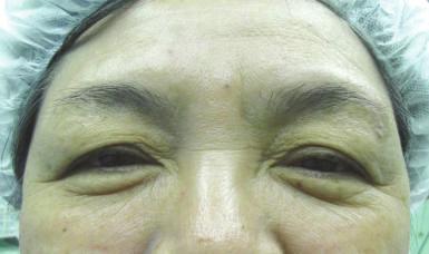 Another benefit of these approaches is that the surgeon can regulate the height of the eyelid crease according to the wishes of the patient.