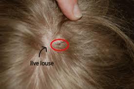 How can I tell if my child has head lice?