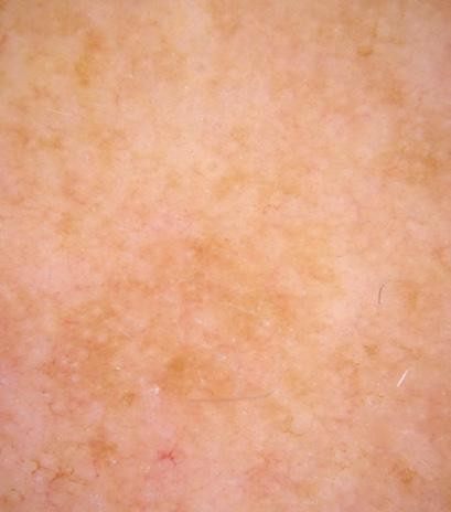 spots, dark spots and UV spots.