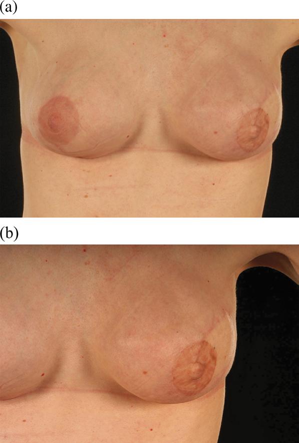 Tattooing of the nipple-areola complex Figure 2 (a, b) e Appearance one year after left side tattooing; patient rated matching as very unsatisfactory (score was 2 out of 10), but Adobe programme