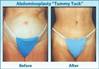 Tuck ) Information Abdominoplasty (Tummy Tuck) Brochure Loose skin, fat deposits, and stretch marks can be unsightly and make the abdomen appear out of balance with the