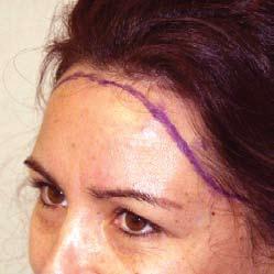 Hairline Procedures ADVANCING OVERLY HIGH HAIRLINES - TWO OPTIONS FOR PATIENTS