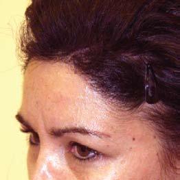 hair loss, two options exist for advancing that hairline and shortening the