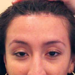 surgical hairline advancement procedure, in which the hairline can be advanced