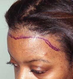 These procedures are described in greater detail at WomensCenterForHairLoss.com.