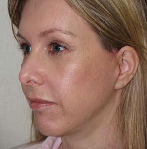 The midfacelift is a popularly selected procedure for both men and women as it addresses the major areas of concern. Note the retention of a natural appearing ear and absence of scarring.