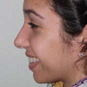 Rhinoplasty NATURALNESS IS THE GOAL No other