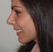 results are a combination of chin implant and