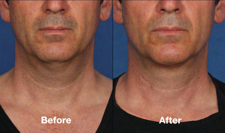 reduce their neck fat with Kybella.