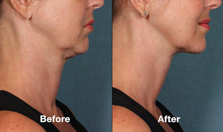 Botulinum toxin (Botox ) can reduce prominent vertical neck bands (platysmal bands), which may appear to look more prominent after