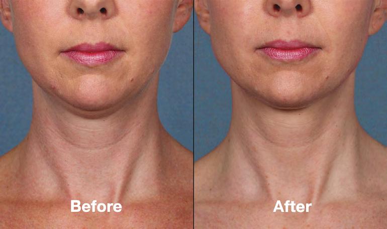 Q&A What happens to my neck skin as I lose the neck fat? For most patients, the skin remains just as tight as before treatment.
