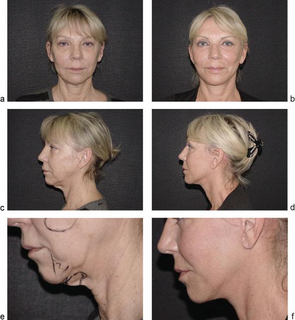 500 Botti, Botti Discussion As was mentioned in the Preface, for more than 15 years we have performed every single facelift according to the protocol described in these pages.