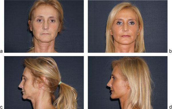 Botti, Botti 501 Fig. 11 Facelift and conspicuous lipofilling. Before (a and c)and9monthsafter(b and d) the operation.