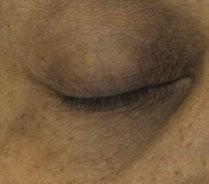 in the appearance of total wrinkle count BEFORE AFTER Clinical Instrumentation Results After 2 weeks 63% showed measured improvement in the appearance of fi rmness in the eye area 75% showed measured