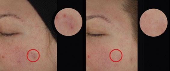 Clinical Grading Results After 3 days 38% showed a reduction in acne blemishes 76% showed visible improvement in skin redness 100%