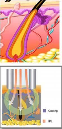 IPL(Intense Pulsed LIght System) Working Theory 1) IPL (Intense Plused Light) 2) Skin contact cooling Theory 1.