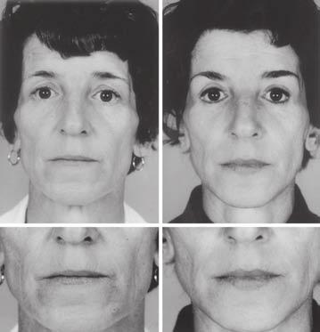 Vol. 112, No. 2 / 673 CORRECTION OF THIN LIPS F IG. 3. ( Left) Preoperative views of a 50-year-old woman with flattened lip contours and upper lip elongation.