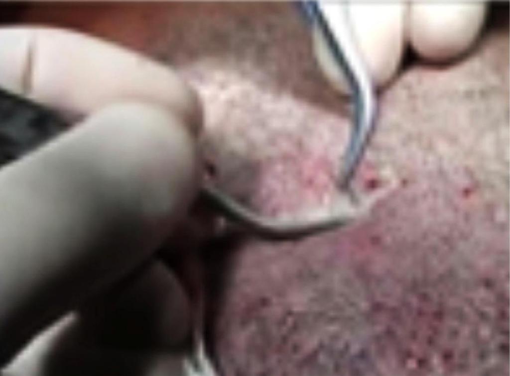 WE USE 2 FORCEP,BACK RETRACTION OF SKIN TECHNIQUE TO PREVENT GRAFT