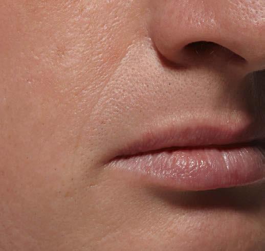 areas such as nasolabial folds, yet soft enough to treat less severe areas such